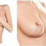 Mamoplastia: Aumento de senos